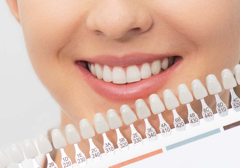 ホワイトニング